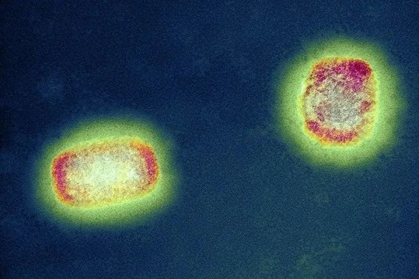 Tes Cepat Antigen: Akankah monkeypox, diabaikan oleh dunia, menjadi penyakit super menular berikutnya?